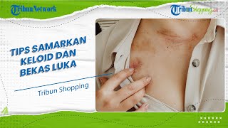 Rekomendasi Obat yang Paling MUJARAB untuk Menghilangkan Keloid dan Bekas Luka