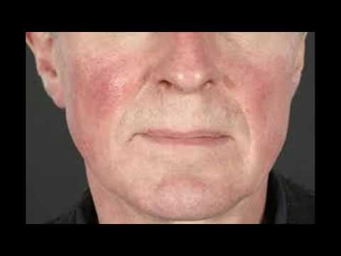 Hund mit chronischer Prostatitis Wie zur Behandlung von Prostatitis letzten