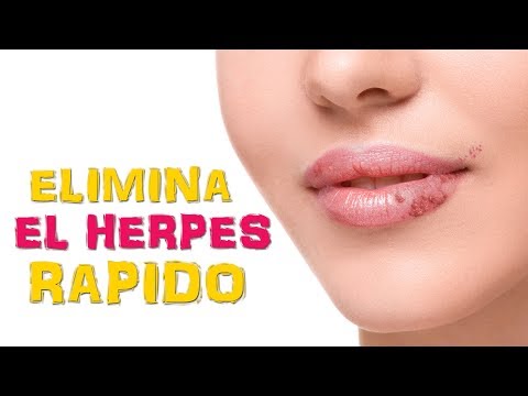 Remedios caseros para el herpes labial