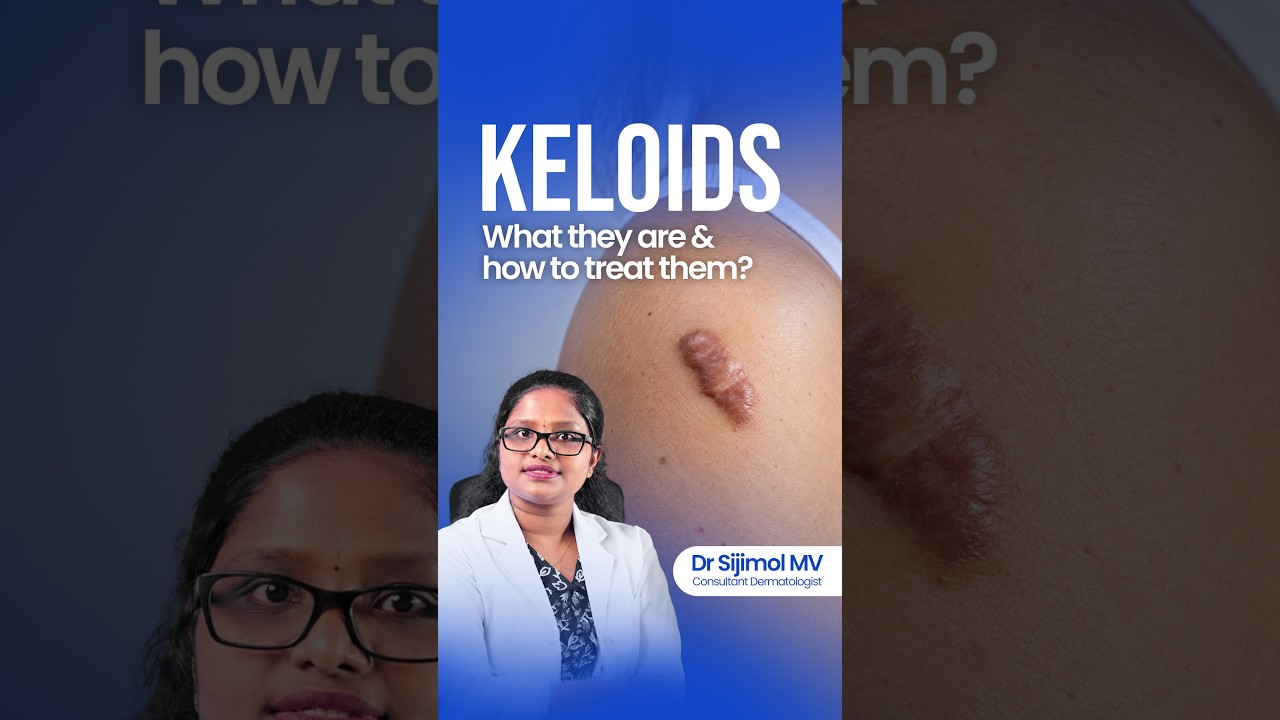 Keloids:  What they are & how to treat them! #dermatology #skincare #malayalamhealthtips