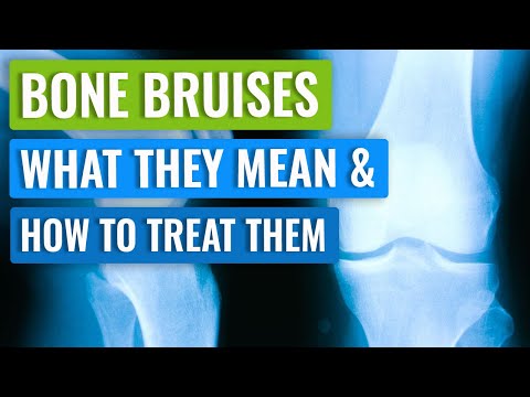 Bone Bruising in the Knee - Causes, Symptoms, and Treatment