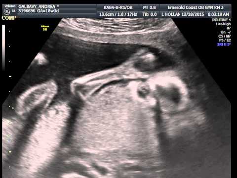 2015-12-18 Andrea Baby Ultrasound 2