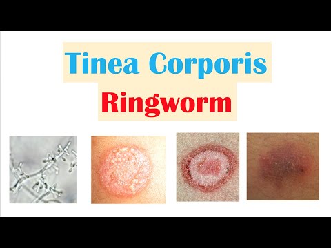 YouTube video about What is Ringworm Tinea Corporis and How to Treat It