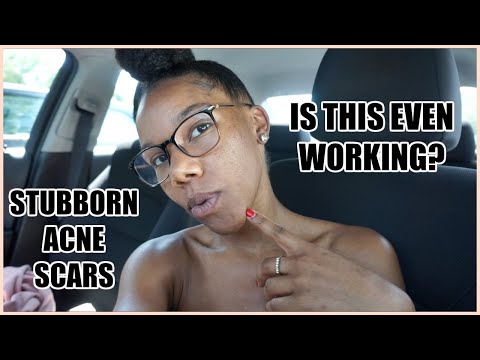 Procell Therapy Treatment | Skin Vlog #4