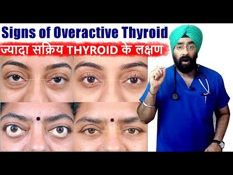 Rx Thyroid #4 (Hindi) ज्यादा सक्रिय थाइरोइड के लक्षण | Hyperthyroidism |  Dr.Education Video