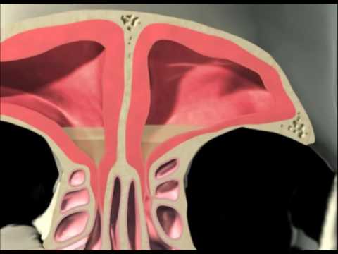 Balloon Sinuplasty & FESS Animation - Houston Nose Surgery Specialist Dr. Michael Eisemann