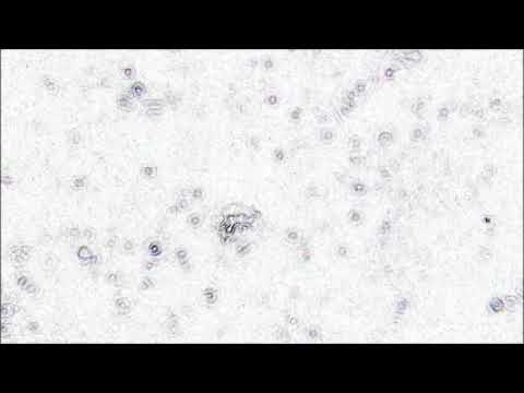 Infiammazione delle articolazioni del piede per guarire Di ridurre linfiammazione in osteocondrosi quali farmaci