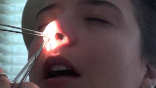 Retirada do Splint Nasal - Septoplastia