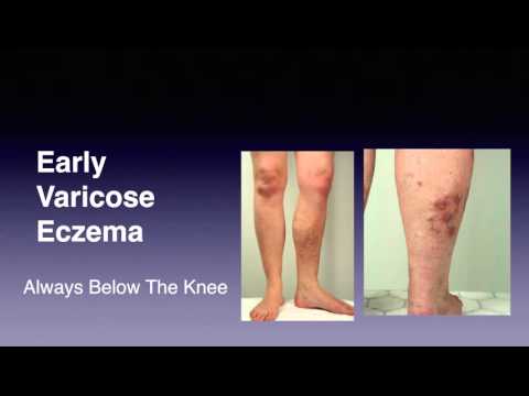 Rimedio efficace allatto di cura di psoriasi Hypostases a eczema