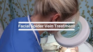 A Simple and Effective Treatment for Facial Spider Veins