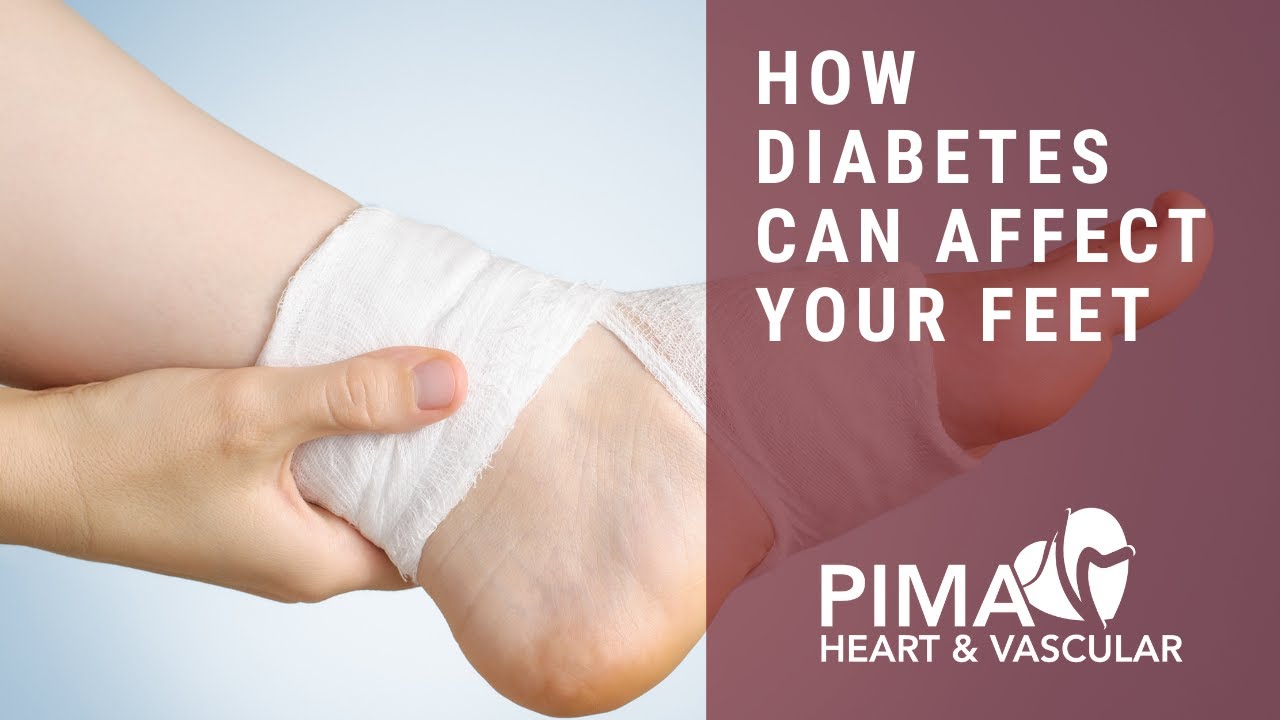 How Diabetes Can Affect Your Feet