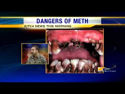 download lagu mp3 mp4 Does Meth Ruin Your Teeth, download lagu Does Meth Ruin Your Teeth gratis, unduh video klip Does Meth Ruin Your Teeth