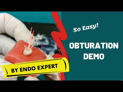 Obturation Made Easy! ENDODONTICS DEMO