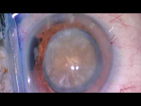 White Mature Cataract Removal - Steve Khachikian