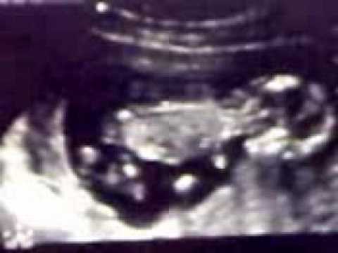 Baby duimt op 13 weken echo