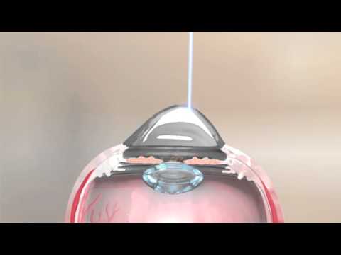 Topography Guided PRK with Simultaneous Collagen Cross Linking