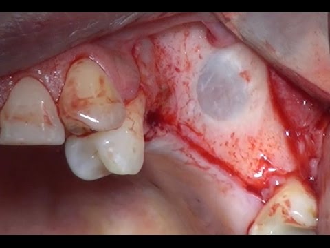 Sinus Lift and Dental Implant