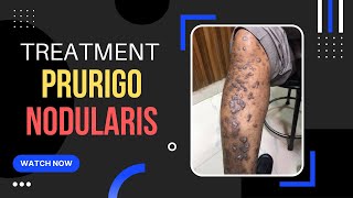 Prurigo Nodular /Eczema Treatment/ ITCHY Skin bump/ एक्जिमा इलाज? Dr Uttam Lenka