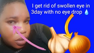 how to get rid of swollen eyelid overnight. how to cure eye infections for 25hour so effective