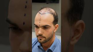 Cosmedica Clinic Hair Transplant in Turkey #shorts #hairtransplant #vi