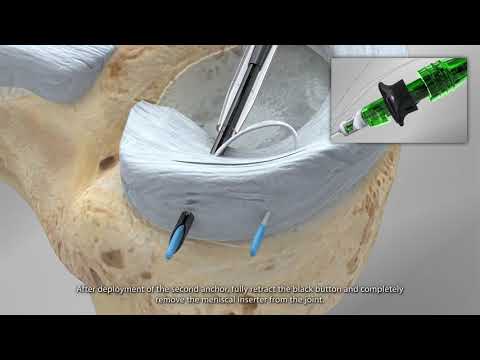JuggerStitch Sistema de reparacion meniscal
