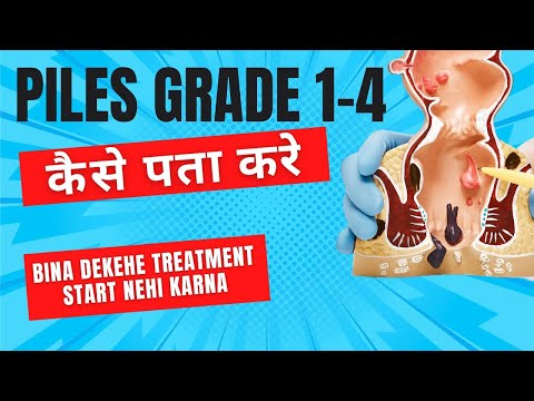 Laser surgery for piles fissure and fistula Laser treatment for piles fissure and fistula benefit