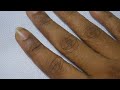 Infectious Skin Diseases In Finger Explanation In Tamil Dr Selvin Innocent Dhas