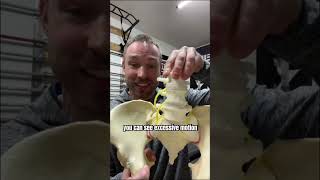 Does Hanging CURE Back Pain?