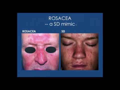 Best cream for psoriasis on face uk