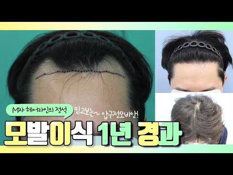 20대 후반 남성,비절개,2800모,M자 모발이식 1년 3개월 경과영상!