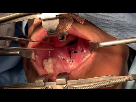 Speech Improvement Surgery