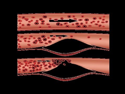 什麼是外周血管疾病？| 心臟病 (What Is Peripheral Vascular Disease? | Heart Disease)