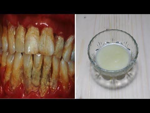 Pasta de dinti cu bicarbonat de sodiu si lămâie poate scapi rapid de tartru fără să mergi la dentist