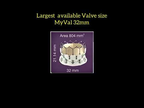 India’s largest Annulus TAVR By Dr Maulik Parekh