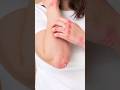 Can You Use Conconut Oil For Fungal Infection Fungalinfection Shorts DMC Drniveditadadu
