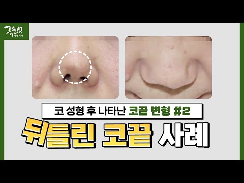 [실제 사례] 코 성형 후 뒤틀린 코끝｜#구축 #실리콘 #보형물｜해결 방법이 있나요?
