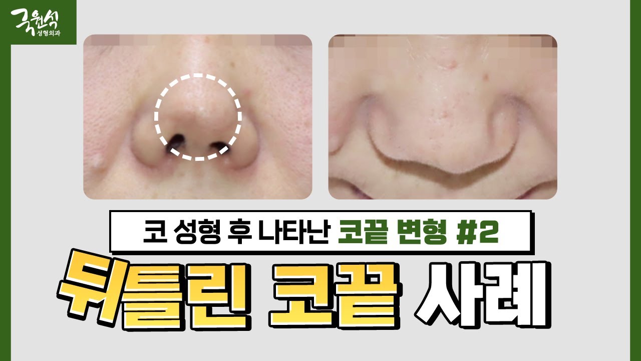 [실제 사례] 코 성형 후 뒤틀린 코끝｜#구축 #실리콘 #보형물｜해결 방법이 있나요? 썸네일