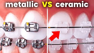 Ceramic Vs Metal Braces….the RIGHT Choice for you | Orthodontist explains