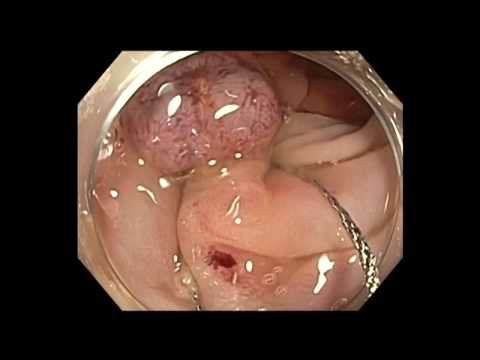 Colonoscopy: Sigmoid Colon Polyp Resection Strategy