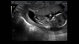 Sherylle & Richard Baby Echo 14 weeks. Gender announcement