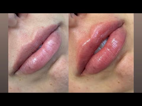 Sabrina injects/ Vanessa injects: lip filler experience!
