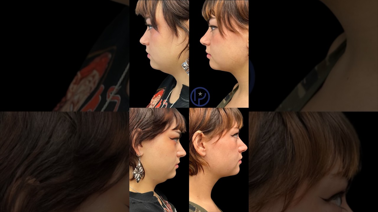 Chin Lipo!