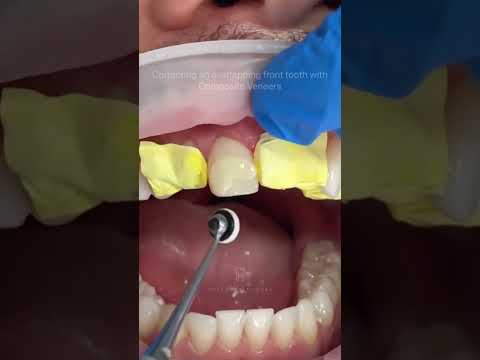 Correcting crooked teeth using 6 direct composite veneers. No braces were used for this makeover✨