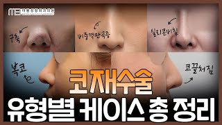 코재수술, 전후사진으로 보는 4가지