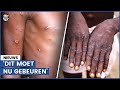 Apenpokkenvirus rukt op: ‘Kan dodelijk zijn’