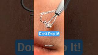 Don't Pop That Whitehead!