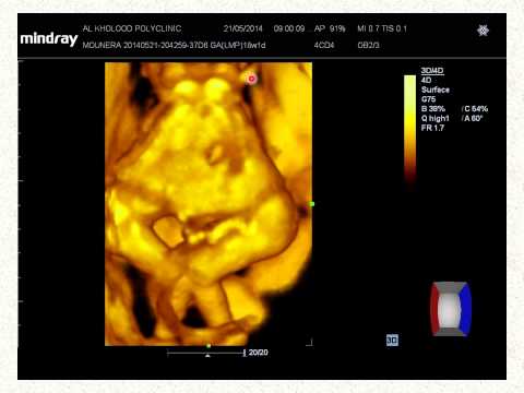 Case 7 Study Fetal Conjioned Twin