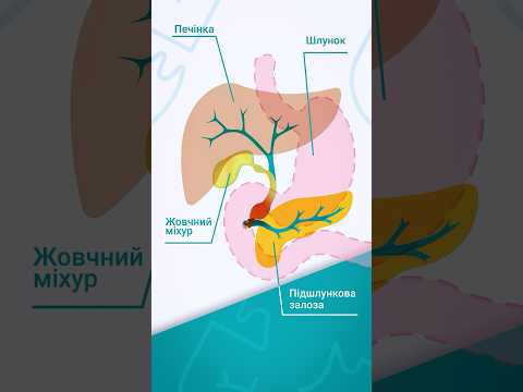 ургентная холецистектомия