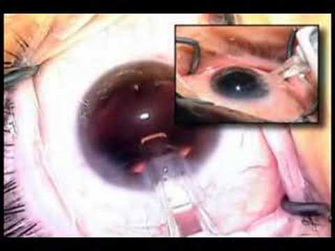 IOL Insertion - Cataract Surgery