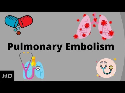 Pulmonary embolism, Causes, Signs and Symptoms, Diagnosis and Treatment.